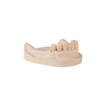 မြင့်မားသော translucet သွားဘက်ပေါင်း zirconia